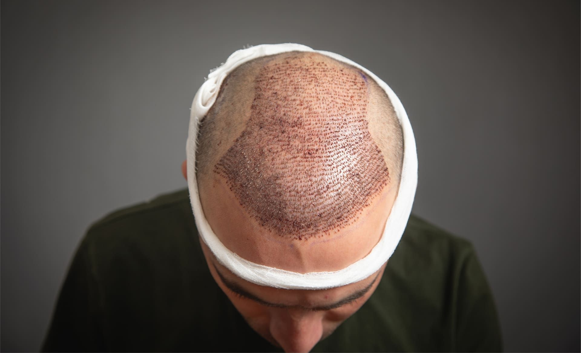 5 VIP-tips om herstel na een haartransplantatie te versnellen