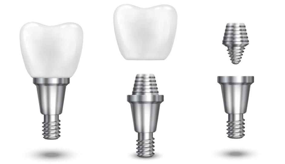 Implantaten & glimlachontwerp